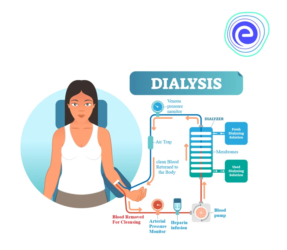 Process of Dialysis