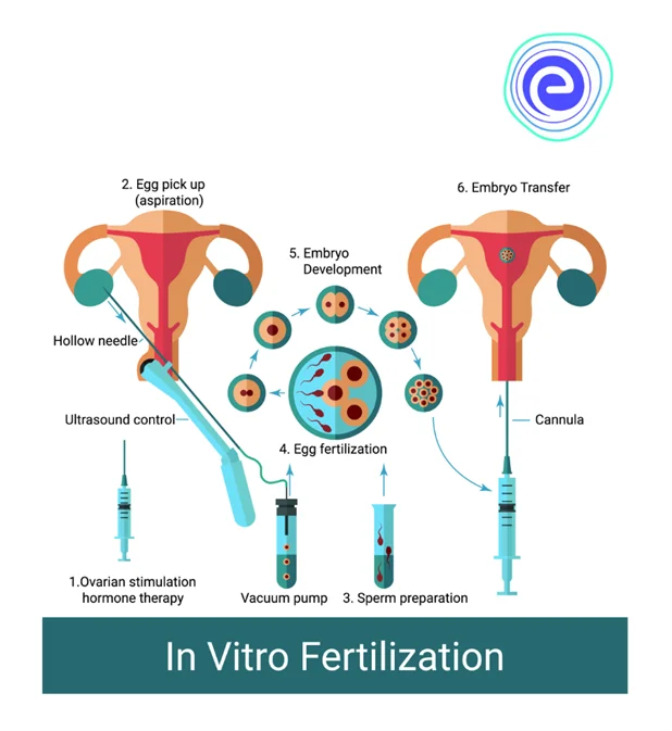 In Vitro Fertilisation